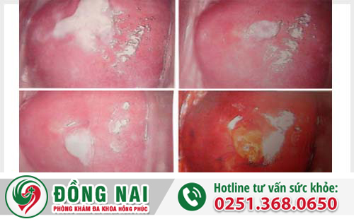 Dấu hiệu tiểu buốt có máu hoặc có mủ ở nữ giới