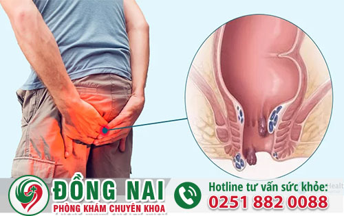 Những Dấu Hiệu Nhận Biết Bệnh Trĩ