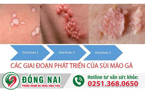4 căn bệnh tình dục phổ biến và nguy hiểm