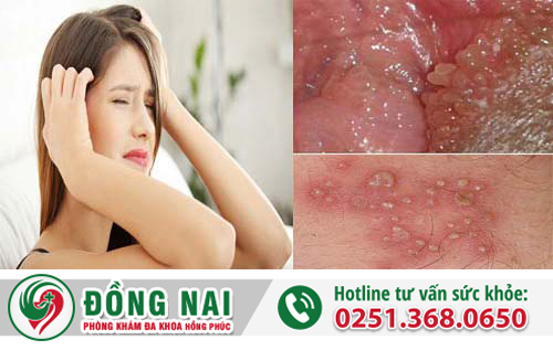 Mụn nước sinh dục – Bệnh không của riêng ai