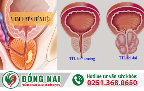 Bạn biết gì về các bệnh tuyến tiền liệt?