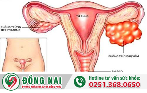 Bạn hiểu biết gì về bệnh viêm buồng trứng