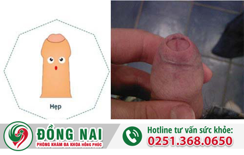 Bao quy đầu bị hẹp có phải là do bẩm sinh không?