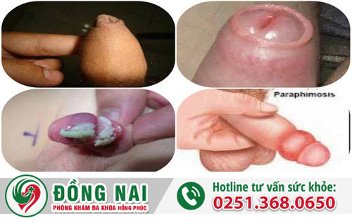bao-quy-dau-nhu-the-nao-la-dai-lieu-co-gay-nguy-hiem-gi-khong
