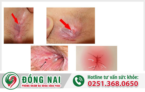Nứt kẽ hậu môn