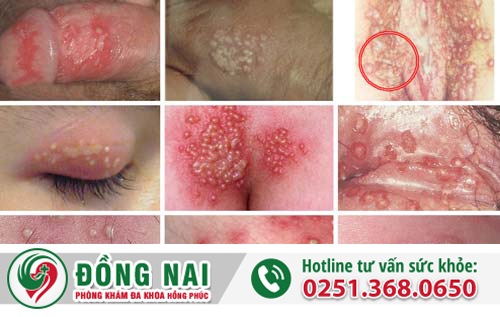 Bệnh do Herpes Simplex Virus gây ra là bệnh gì?