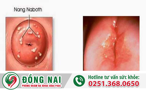 Bệnh Nang naboth và cách chữa trị