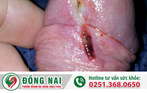 Bị rách bao quy đầu khi quan hệ thì phải làm sao?