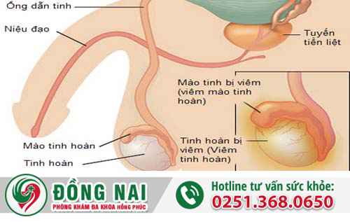 Biến chứng từ bệnh quai bị - Viêm tinh hoàn