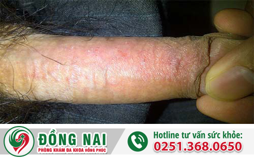 Bốn bệnh nam khoa thường quấy rầy cậu bé