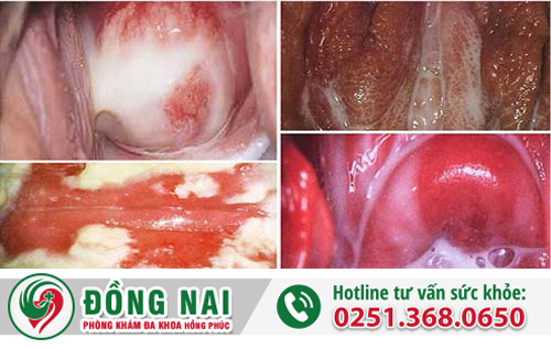 Bốn bệnh phụ khoa thường gặp ở các chị em phụ nữ