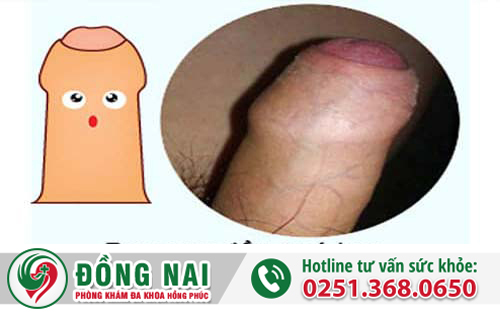 Cách điều trị hẹp bao quy đầu an toàn hiệu quả
