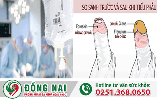 Cách điều trị hẹp bao quy đầu an toàn hiệu quả