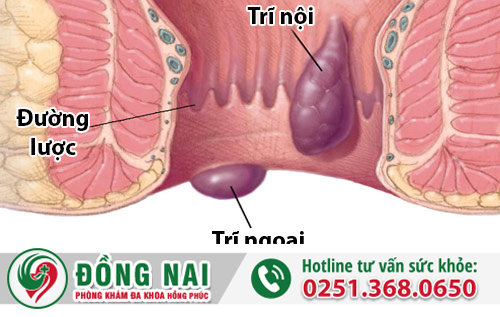 Trĩ hỗn hợp là khi người bệnh mắc cùng lúc trĩ nội và trĩ ngoại