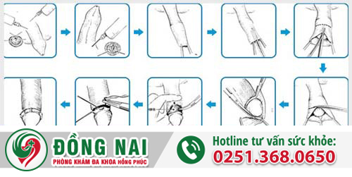 Điều trị dài bao quy đầu tại nhà