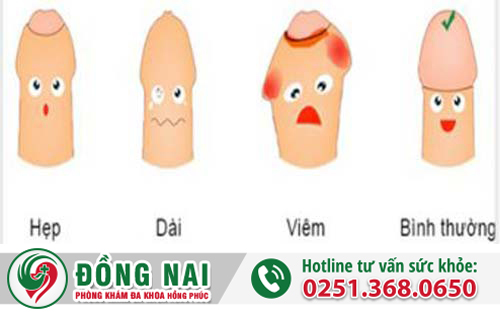 Cắt bao quy đầu ở đâu đồng nai an toàn và giá tốt nhất
