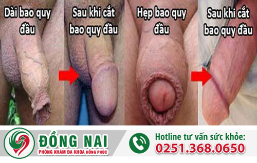 Cắt bao quy đầu nên thực hiện ở đâu cho an toàn?