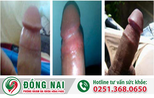 Cắt bao quy đầu theo công nghệ Hàn Quốc không gây đau