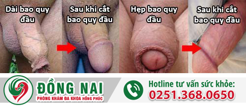 Hẹp bao quy đầu làm dương vật bị ngắn?