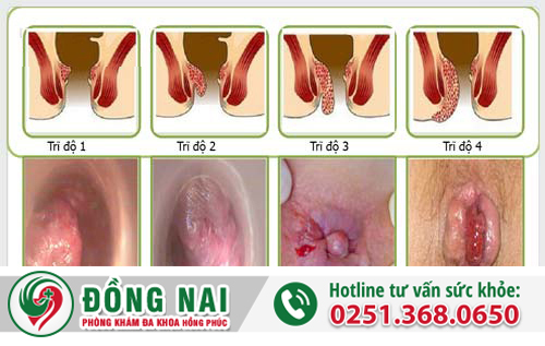 Bệnh trĩ gây chảy máu hậu môn