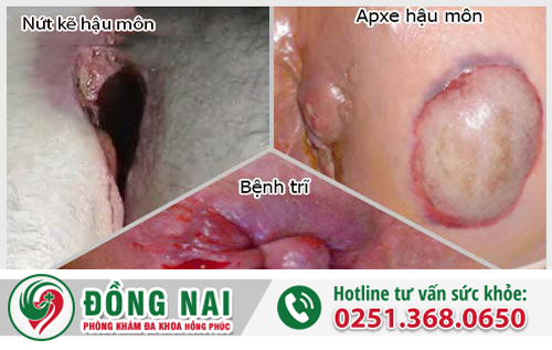 Chảy mủ hậu môn là bệnh gì?