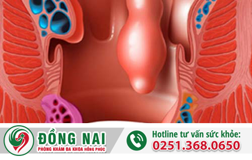 Chi phí cắt trĩ là bao nhiêu?