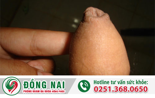 Bốn biểu hiện chính của dài bao quy đầu