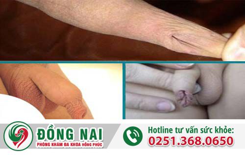 Dài bao quy đầu phải chữa trị làm sao?