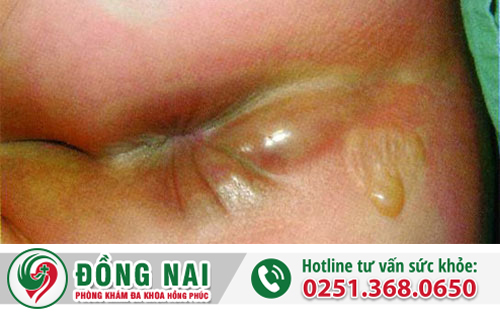 Đau hậu môn là bệnh gì?