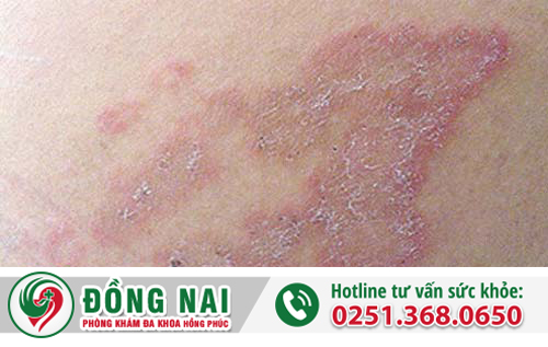 Dấu hiệu nhận biết bệnh chàm hậu môn là gì?