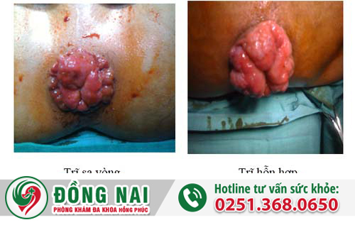 Dấu hiệu nhận biết bệnh trĩ vòng