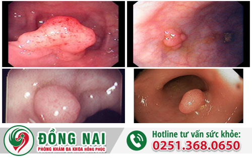 Phân biệt bệnh trĩ ngoại với polyp hậu môn