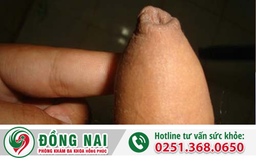 Điều trị dài bao quy đầu ra sao?