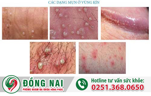 Mụn nhọt vùng kín có phải là biểu hiện bệnh?