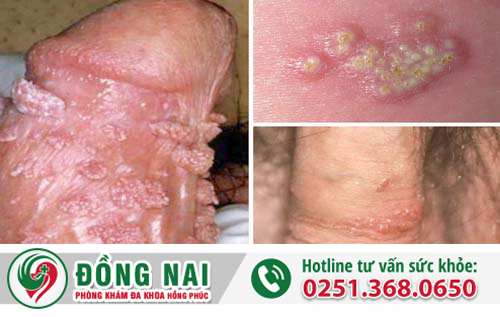 Khi nào thì nam giới bị nổi mụn vùng kín?