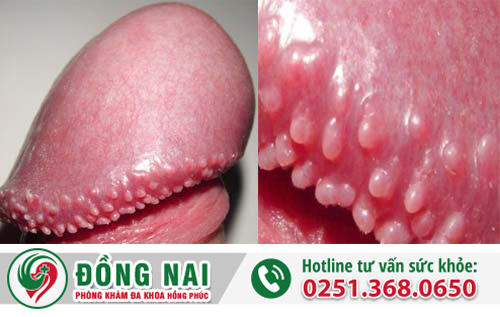 dương vật nổi mụn trắng