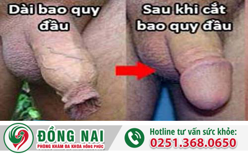 Giải thích hiện tượng dài bao quy đầu và phương pháp điều trị
