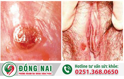 hình ảnh giang mai ở nữ giai đoạn đầu