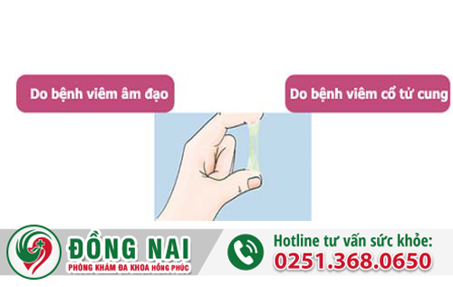 Hai bệnh lý phổ biến với dấu hiệu khí hư ra nhiều