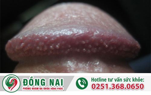 Hạt ngọc dương vật và những điều nam giới cần biết