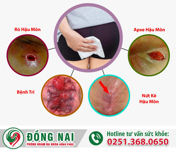 Hậu môn ẩm ướt, có mùi hôi là bị gì?