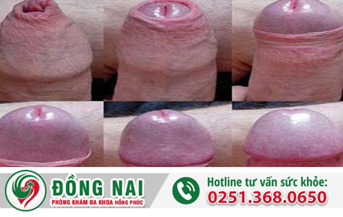 Hẹp bao quy đầu có vô sinh không, quan hệ liệu có thai không?
