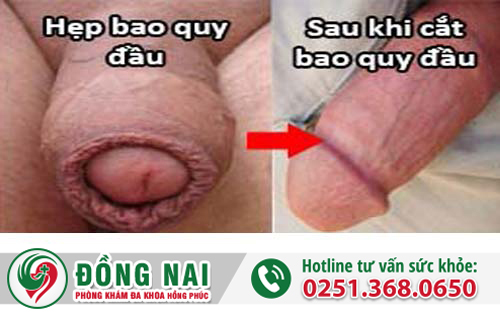 Hẹp bao quy đầu để lâu có nguy hiểm không và cách điều trị ra sao?