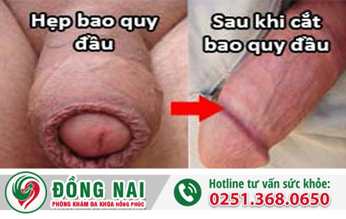 Hẹp bao quy đầu là gì?