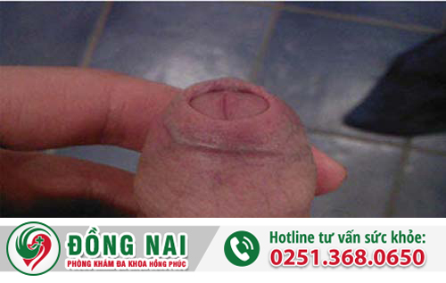 Hẹp bao quy đầu nên điều trị ở đâu mới tốt?