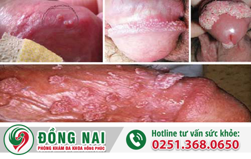 Một số hình ảnh gai sinh dục nam và nữ - Dấu hiệu nhận biết và cách chữa
