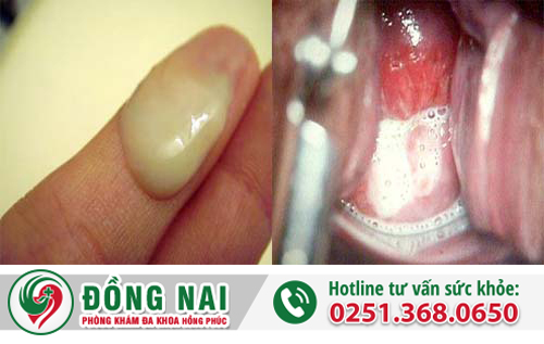 Khí hư ra nhiều bạn phải làm sao?