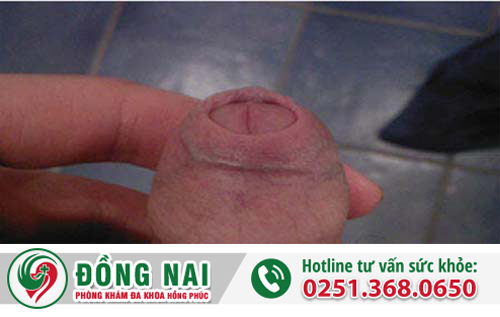 Làm sao để biết có bị hẹp bao quy đầu hay không?