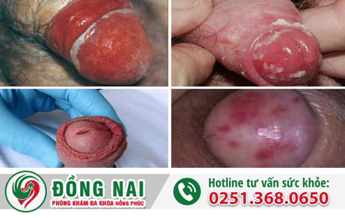 Làm sao để biết có bị hẹp bao quy đầu hay không?