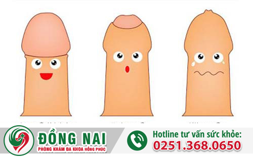 Lột bao quy đầu gì? Và cách lột như thế nào?